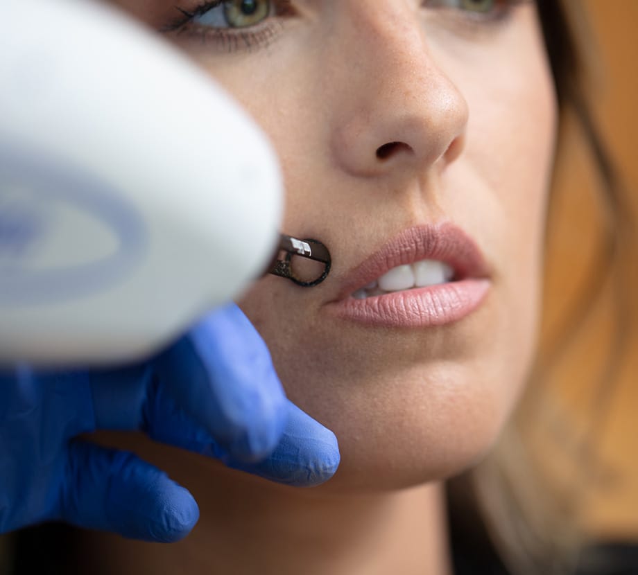 Acne Scar Treatment Pittsburgh
